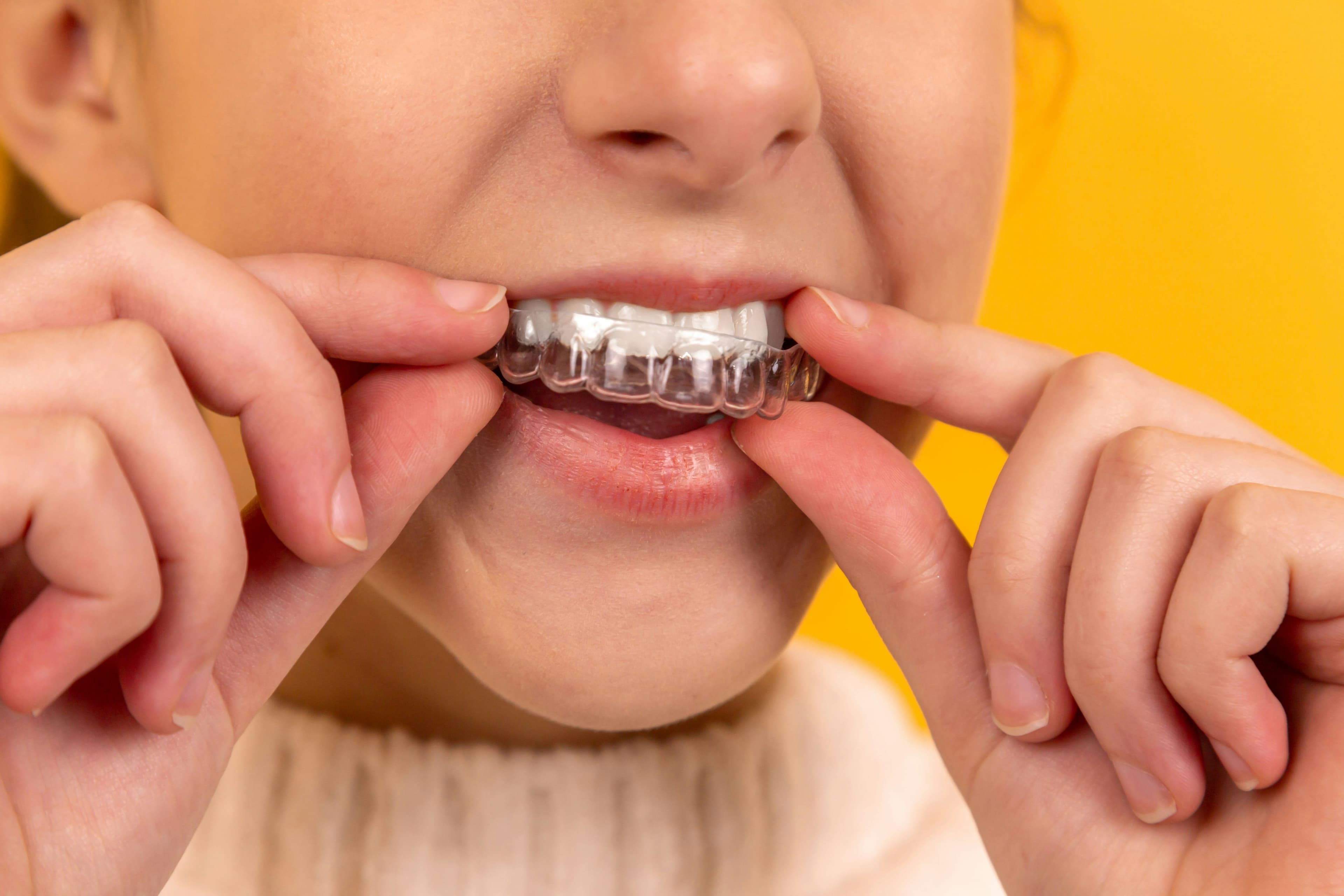 Como escolher o tratamento ideal para alinhar os dentes