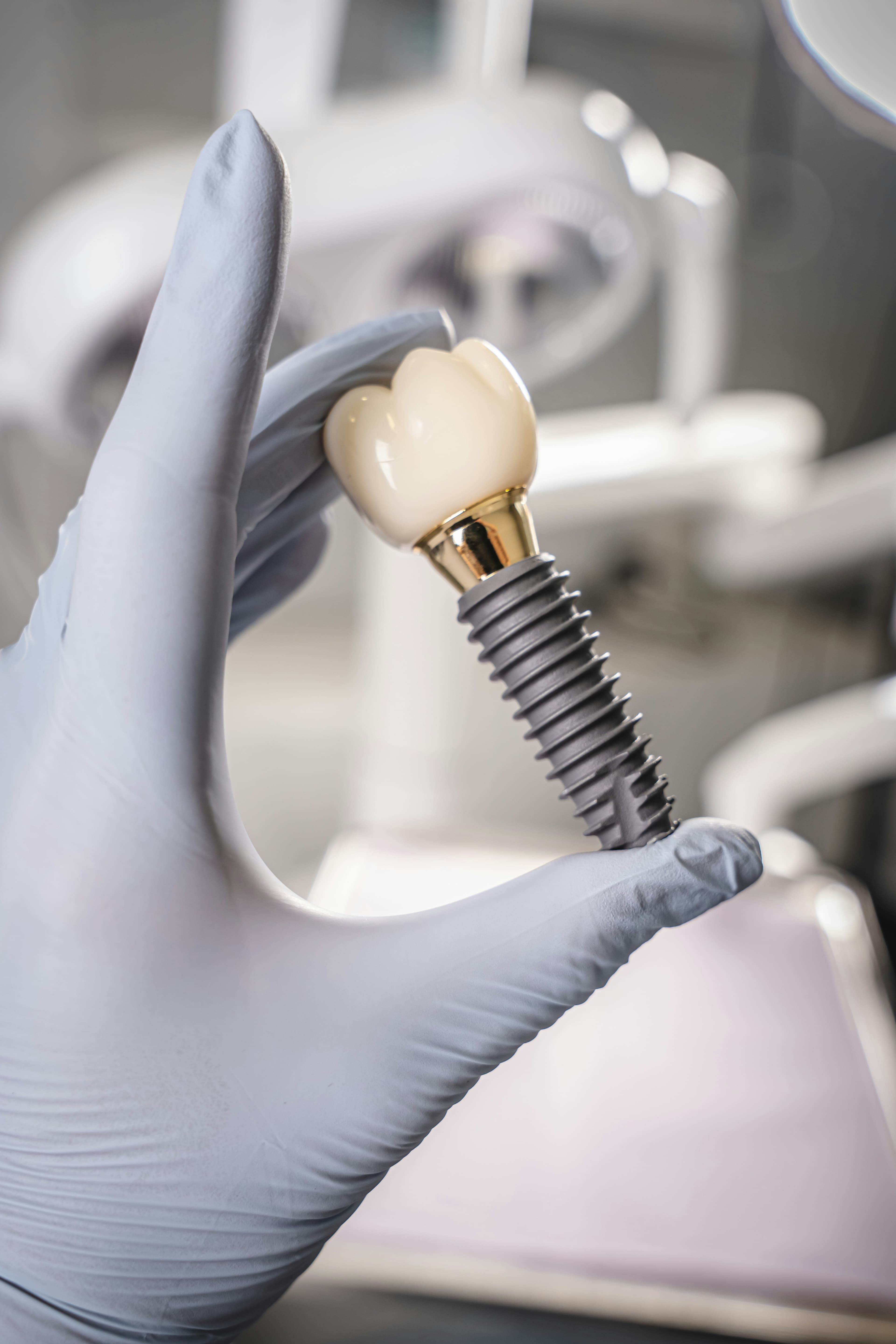 Implante dentário: o que esperar em cada etapa do tratamento